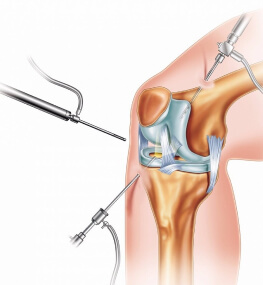 Артроскопія